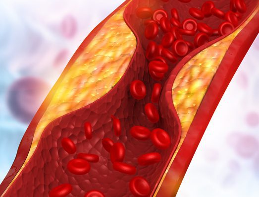 carolina-cardiology-associates-coronary-artery-disease